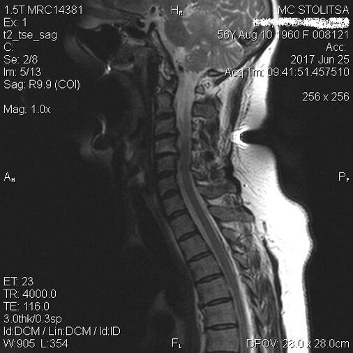 Kohdunkaulan selkärangan osteokondroosi ja spondyloosi