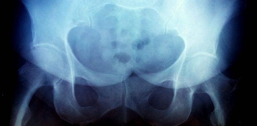 X -ray -kuva artroosista 2. asteesta